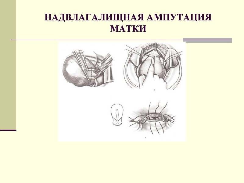 НАДВЛАГАЛИЩНАЯ АМПУТАЦИЯ МАТКИ